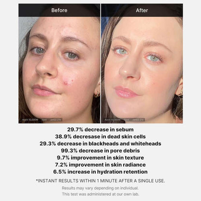 Medicube | Red Acne Succinic Acid Peel