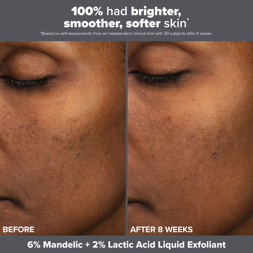 Paula’s Choice | Skin Perfecting Mandelic & Lactic Acid Liquid Exfoliant